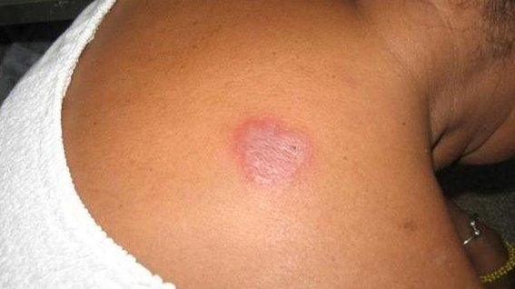 Ssa desmiente brote de lepra en Chiapas